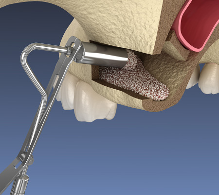 インプラント治療骨造成術サイナスリフトのイメージ図